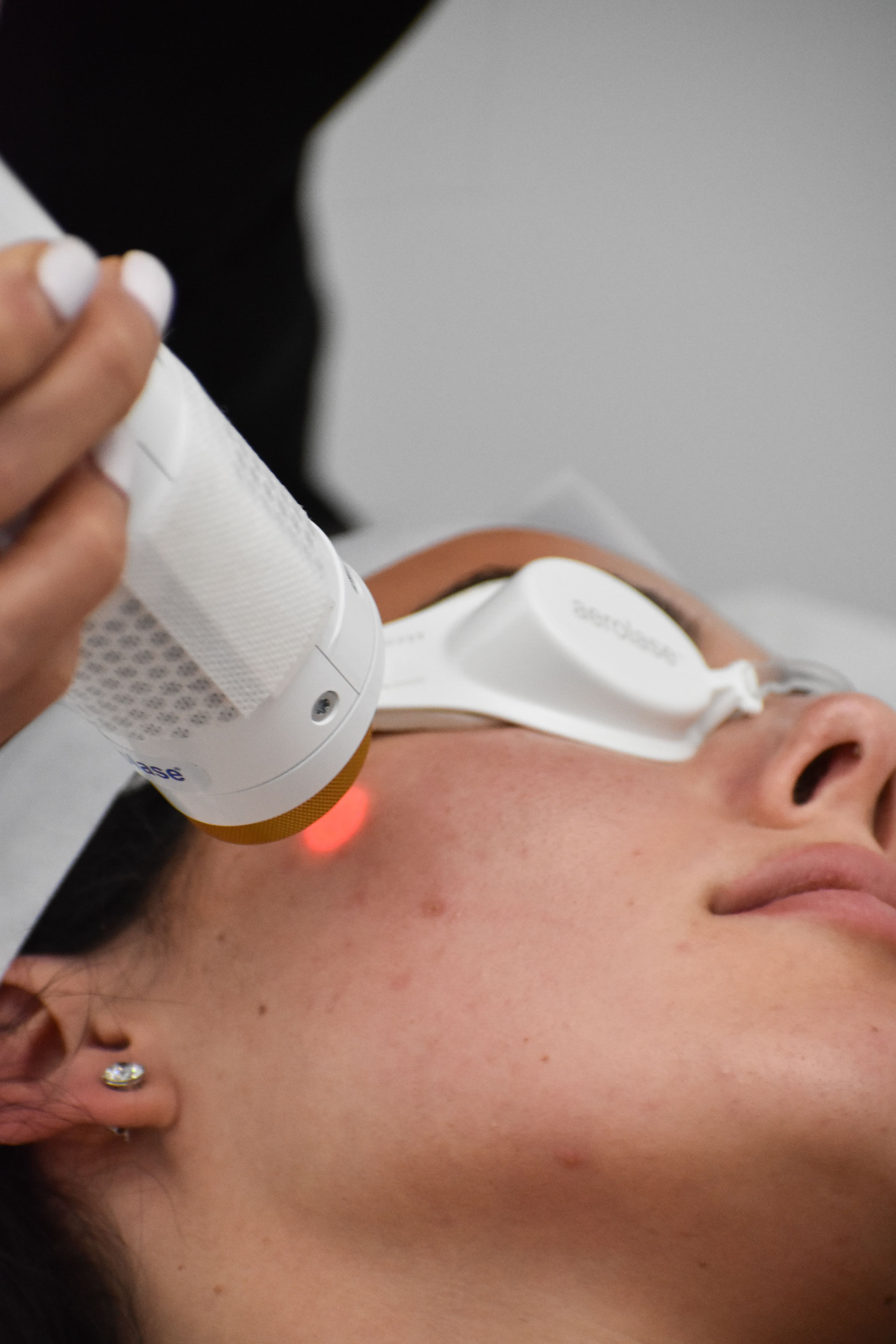 Aerolase Neo Elite laser treatment for skin rejuvenation in Miami